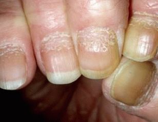 псориазис на ноктите