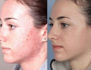 снимка на кожата на лицето след лечение на псориазис