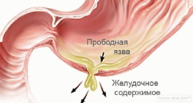 Перфорирана (перфоративна) стомашна язва идуоденална язва